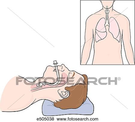 Main image shows how, when properly positioned, the cuff of the endotracheal tube should be just below the vocal cords. Insert shows how the distal tip of the tube should be above the carina. View Large Illustration Stock Illustration - Main image shows how, when properly positioned, the cuff of the endotracheal tube should be just below the vocal cords. Insert shows how the distal tip of the tube should be above the carina.. Fotosearch
