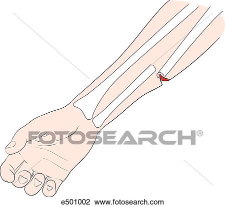 Open fracture of the radius penetrating the skin. View Large Illustration Drawing - Open fracture of the radius penetrating the skin.. Fotosearch