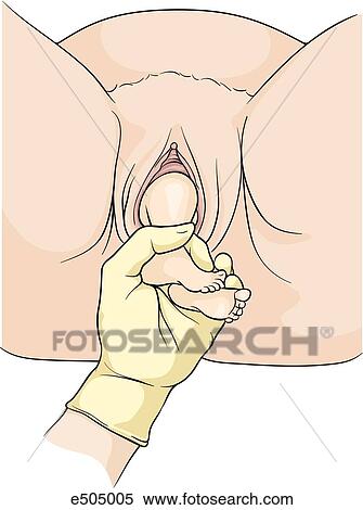 Stock Illustration - (Step 1) Feet brought down by gentle traction until they appear at vulva.. Fotosearch
