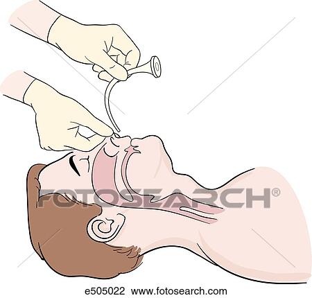 Drawing - (Step 1) Hold airway open so that its curvature follows that of the floor of the nose.. Fotosearch