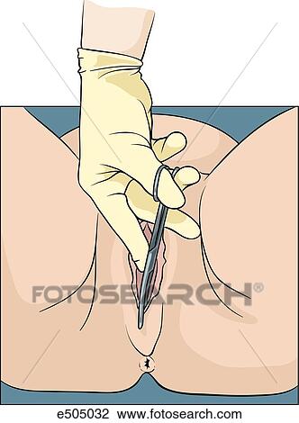 Clip Art - (Step 1) Midline episiotomy is made with sharp scissors to relax perineum.. Fotosearch - Search Clipart, Illustration Posters, Drawings, and EPS Vector Graphics Images