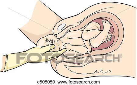 (Step 1) Posterior humerus splinted by physician's hand as posterior arm is swept across chest while keeping arm flexed at elbow. View Large Illustration Clipart - (Step 1) Posterior humerus splinted by physician's hand as posterior arm is swept across chest while keeping arm flexed at elbow.. Fotosearch