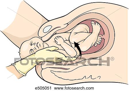Clip Art - (Step 2) Hand of fetus is grasped under pubic symphysis, and arm is extended along side of fetus' face.. Fotosearch
