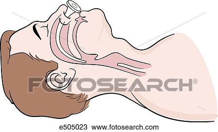 Drawing - (Step 2) Slide the airway into the nostril until its flange is flush against the opening of the nostril; at that point distal end will be in the oropharynx.. Fotosearch