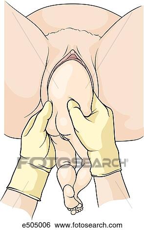 (Step 2) Thumbs are placed over the posterior iliac spines and sacroiliac area and hands are placed around infant's pelvis anteriorly. Downward traction is applied until the rib cage is visualized. View Large Illustration Stock Illustration - (Step 2) Thumbs are placed over the posterior iliac spines and sacroiliac area and hands are placed around infant's pelvis anteriorly. Downward traction is applied until the rib cage is visualized.. Fotosearch