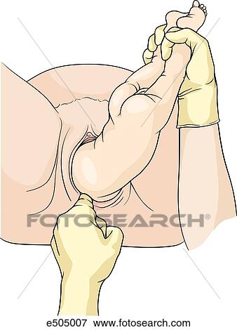 (Step 3) The finger is inserted to aid in the passage of the posterior shoulder. View Large Illustration Stock Illustration - (Step 3) The finger is inserted to aid in the passage of the posterior shoulder.. Fotosearch