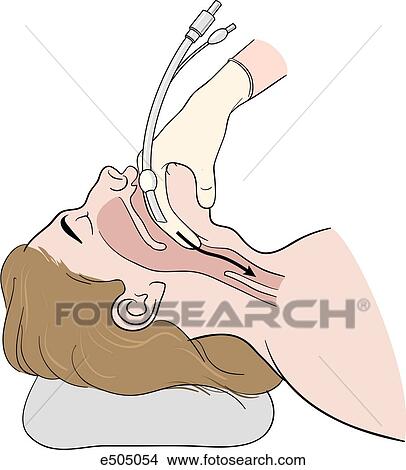 Technique of tubal intubation. Patient's neck is hyperextended and the epiglottis is pulled toward toward the rescuer with left index finger. Tube is advanced slowly along the outer surface of finger. View Large Illustration Stock Illustration - Technique of tubal intubation. Patient's neck is hyperextended and the epiglottis is pulled toward toward the rescuer with left index finger. Tube is advanced slowly along the outer surface of finger.. Fotosearch