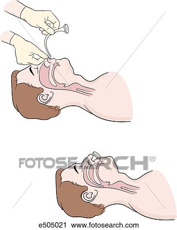 Clip Art - Two part procedure for inserting a nasopharyngeal airway. (Top) Hold airway open so that its curvature follows that of the floor of the nose. (bottom) Slide the airway into the nostril until its flange is flush against the opening of the nostril; at that. Fotosearch