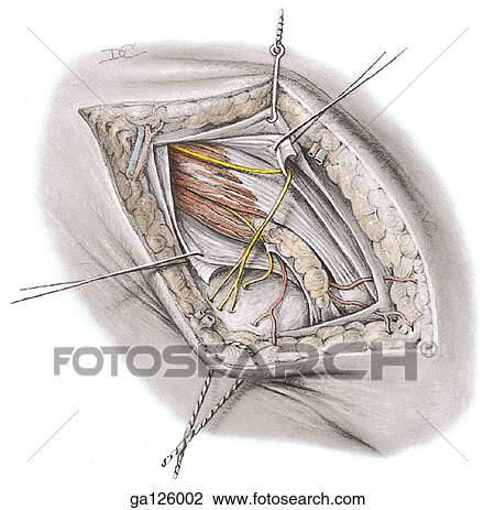 前方の眺め の 構造 中に 女性 Inguinal Canal Aponeurosis の 斜め外面 持つ ある 切口 そして 引っ張られる わきに へ 明らかにしなさい Cremaster そして 内部 斜め Muscloes スケッチ Ga