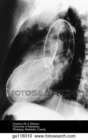 左 冠状 Arteriogram 提示 左 冠状動脈 止めること 近くに 大動脈 Valve 方向づけ 図画 ある 数字 1 47d クリップアート 切り張り イラスト 絵画 集 Ga Fotosearch 左 冠状 Arteriogram 提示 左 冠状動脈 止めること 近くに 大動脈 Valve 方向づけ 図画 ある 数字 1 47d クリップアート 切り張り イラスト 絵画 集 Ga Fotosearch