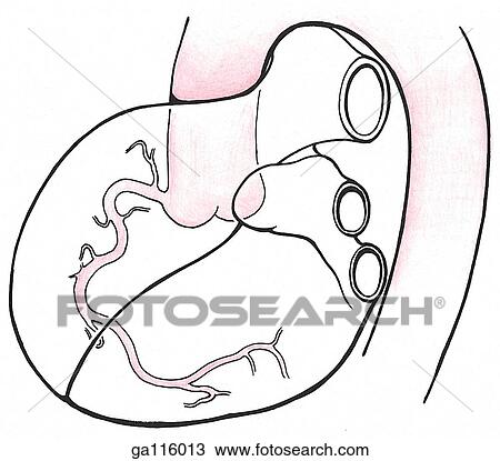 A simple orientation drawing for a right coronary arteriogram showing the right coronary artery stemming near the aortic valve. Corresponding arteriogram is figure 1. 47B. View Large Illustration Drawing - A simple orientation drawing for a right coronary arteriogram showing the right coronary artery stemming near the aortic valve. Corresponding arteriogram is figure 1. 47B.. Fotosearch