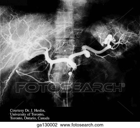 Drawing - Anterior view of a celiac arteriogram showing the hepatic and the right gastroepiploic arteries following the gastric curves.. Fotosearch