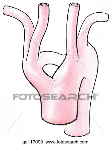 Anterior view of aortic arch anomaly where right and left aortic arches persist completely, as in the frog, forming an aortic ring through which pass the esophagus and trachea. View Large Illustration Stock Illustration - Anterior view of aortic arch anomaly where right and left aortic arches persist completely, as in the frog, forming an aortic ring through which pass the esophagus and trachea.. Fotosearch