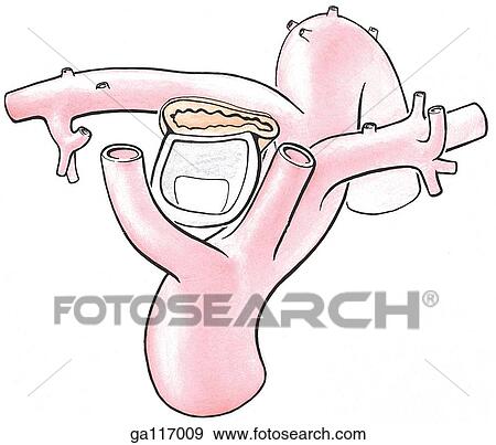 Stock Illustration - Anterior view of aortic arch anomaly where right subclavian artery arises as the last branch of the arch of the aorta, passing posteriorly to the esophagus and trachea.. Fotosearch