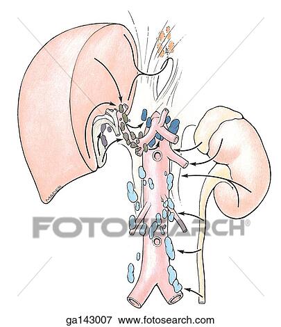 Anterior view of large intestine, isolated and spread to show color coded groups of lymph nodes. Arrows indicate direction of drainage. View Large Illustration Stock Illustration - Anterior view of large intestine, isolated and spread to show color coded groups of lymph nodes. Arrows indicate direction of drainage.. Fotosearch