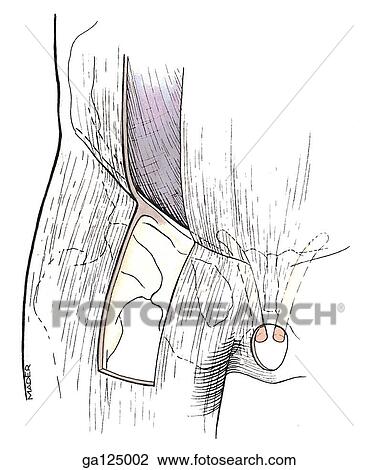 Anterior view of membranous deep layer of superficial fascia of abdomen. Aponeurosis of external oblique muscle highlighted by color. View Large Illustration Drawing - Anterior view of membranous deep layer of superficial fascia of abdomen. Aponeurosis of external oblique muscle highlighted by color.. Fotosearch
