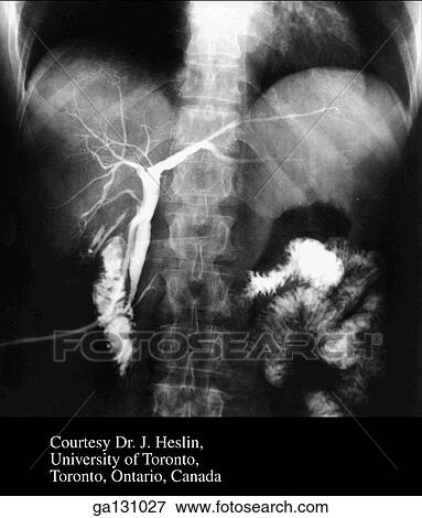 Stock Illustration - Anterior view of radiograph of biliary passages in superior abdomen after cholecystectomy (removal of gallbladder). Contrast medium has been injected with T tube visible lower right.. Fotosearch