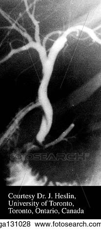 Stock Illustration - Anterior view of radiograph of biliary passages after cholecystectomy (removal of gallbladder).. Fotosearch