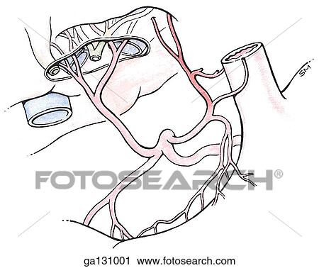 Clip Art - Anterior view of the celiac artery and the vessels that originate from it. In this illustration an aberrant left hepatic artery branches off the left gastric artery at the level of its esophageal branch.. Fotosearch
