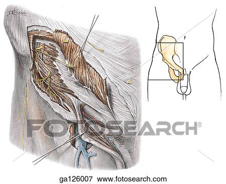 Stock Illustration - Anterior view of the male inguinal region. Internal oblique muscle is reflected, and the spermatic cord retracted. Square in insert image of right pelvis indicates area shown in main image.. Fotosearch