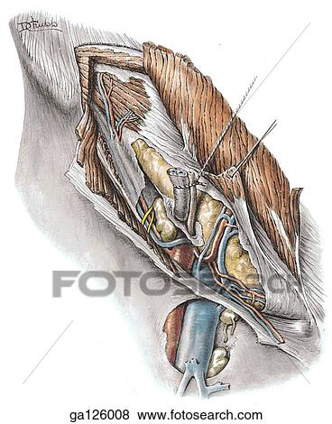 Stock Illustration - Anterior view of the male inguinal region. Internal oblique muscle is reflected, and the spermatic cord retracted. Square in insert image of right pelvis indicates area shown in main image.. Fotosearch