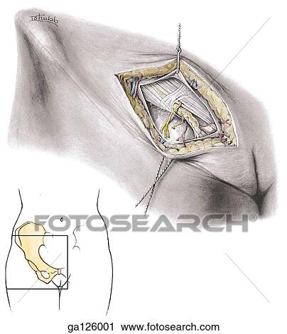 Anterior view of the superficial structures in the female inguinal canal. Square on insert image shows orientation of main image. View Large Illustration Clip Art - Anterior view of the superficial structures in the female inguinal canal. Square on insert image shows orientation of main image.. Fotosearch