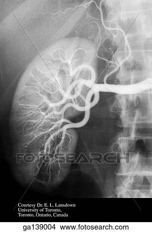 Anteroposterior renal arteriogram illustrating the renal arteries and segmental branches. View Large Illustration Stock Illustration - Anteroposterior renal arteriogram illustrating the renal arteries and segmental branches.. Fotosearch