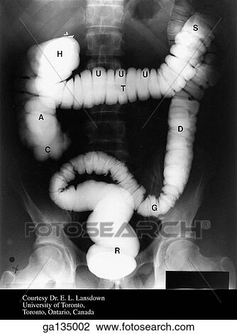 Drawing - Anteroposterior single contrast study barium enema of colon. A barium enema has filled the colon.. Fotosearch
