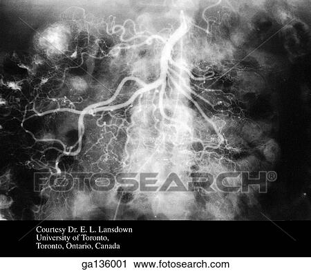Anteroposterior superior mesenteric arteriogram showing blood supply to intestinal region. View Large Illustration Clip Art - Anteroposterior superior mesenteric arteriogram showing blood supply to intestinal region.. Fotosearch