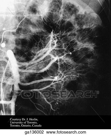 Drawing - Anteroposterior superior mesenteric arteriogram showing jejunal branches, arterial arcades and vasa recta.. Fotosearch