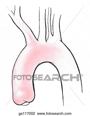 Aortic arch anomaly where each of four arteries originates independently from the arch. Shown are: brachiocephalic trunk, right subclavian artery, right common carotid artery, left common carotid artery, left subclavian artery, and left vertebral artery View Large Illustration Drawing - Aortic arch anomaly where each of four arteries originates independently from the arch. Shown are: brachiocephalic trunk, right subclavian artery, right common carotid artery, left common carotid artery, left subclavian artery, and left vertebral artery. Fotosearch
