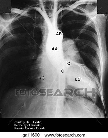 Aortic root angiogram showing the arch of the aorta (AR), ascending aorta (AA), cusp of aortic valve (C), left coronary artery (LC), and right coronary artery (RC). View Large Illustration Clip Art - Aortic root angiogram showing the arch of the aorta (AR), ascending aorta (AA), cusp of aortic valve (C), left coronary artery (LC), and right coronary artery (RC).. Fotosearch