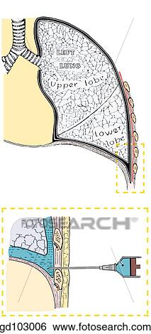 Stock Illustration - At the root of the lung, the parietal pleura is continuous with the visceral pleura. The costal parietal pleura is separated from the thoracic wall by endothoracic fascia. The INSET shows relation for a pleural tap.. Fotosearch