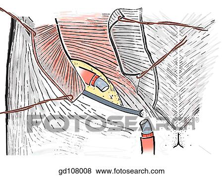 Stock Illustration - Conjoint tendon and fascia transversalis.. Fotosearch