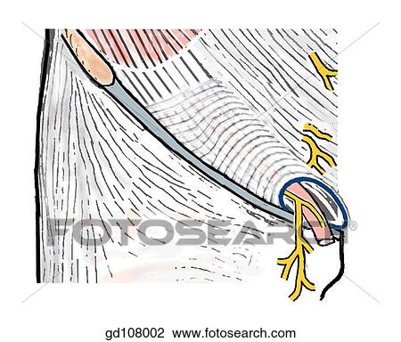 Drawing - Contributions of the three flat abdominal muscles to the inguinal canal.. Fotosearch