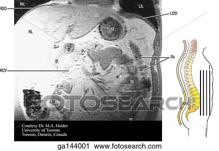 Clip Art - Coronal MRI of the abdomen. Image at right shows level of scan (line A).. Fotosearch