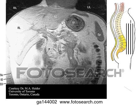 Coronal MRI of the abdomen. Image at right shows level of scan (line B). View Large Illustration Drawing - Coronal MRI of the abdomen. Image at right shows level of scan (line B).. Fotosearch