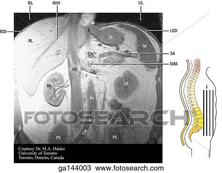 Coronal MRI of the abdomen. Image at right shows level of scan (line C). View Large Illustration Drawing - Coronal MRI of the abdomen. Image at right shows level of scan (line C).. Fotosearch