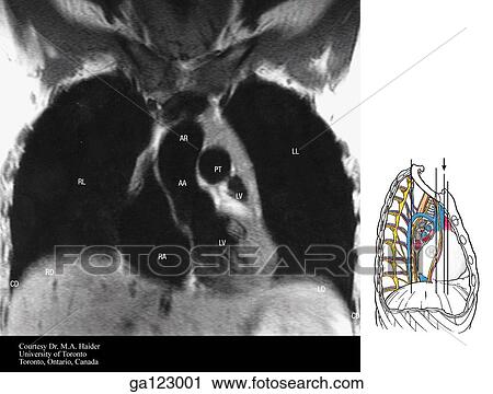 Clip Art - Coronal MRI of the thorax at the level of the arch of aorta. See illustration A1. 76i for orientation. The image to the right indicates the level of each coronal MRI.. Fotosearch