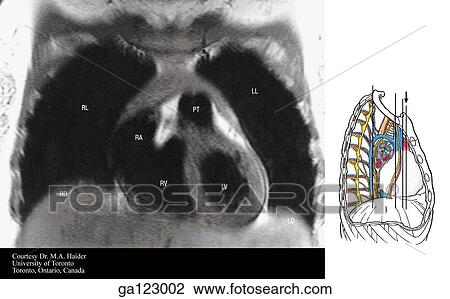 Coronal MRI of the thorax at the level of the ascending aorta. The image to the right indicates the level of each coronal MRI. View Large Illustration Drawing - Coronal MRI of the thorax at the level of the ascending aorta. The image to the right indicates the level of each coronal MRI.. Fotosearch