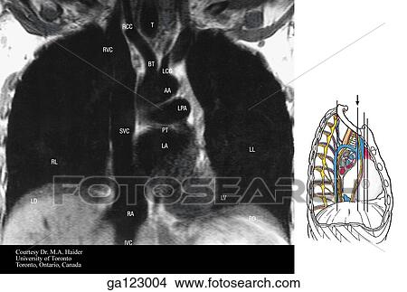 Stock Illustration - Coronal MRI of the thorax at the level of the superior vena cava. The image to the right indicates the level of each coronal MRI.. Fotosearch