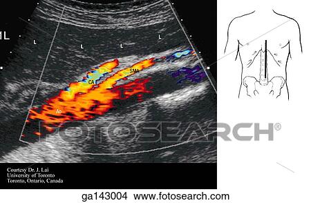 Doppler ultrasound of the abdomen at level of aorta, celiac artery