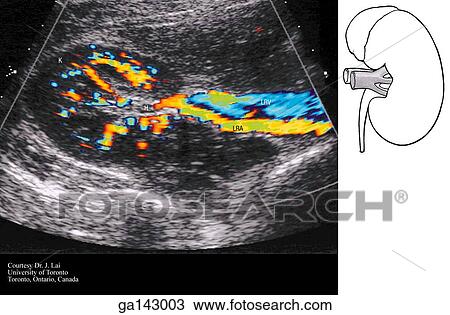 Drawing - Doppler ultrasound of the kidney and renal vessels, transverse view. Image on right shows an anterior view of anatomy seen in the main scan.. Fotosearch