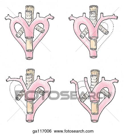 Four variations of the aortic arch are shown: double aortic arch of the frog; right aortic arch of the bird; left aortic arch of the mammal, including man, and a variant with the subclavian artery originating from the descending aorta. View Large Illustration Stock Illustration - Four variations of the aortic arch are shown: double aortic arch of the frog; right aortic arch of the bird; left aortic arch of the mammal, including man, and a variant with the subclavian artery originating from the descending aorta.. Fotosearch