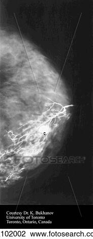 Drawing - Galactogram of breast. Contrast has been injected into a lactiferous duct. A ductal cyst can be seen as the solid white area.. Fotosearch