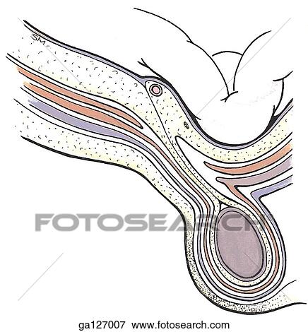 Horizontal section of inguinal canal showing direct inguinal hernia. View Large Illustration Stock Illustration - Horizontal section of inguinal canal showing direct inguinal hernia.. Fotosearch