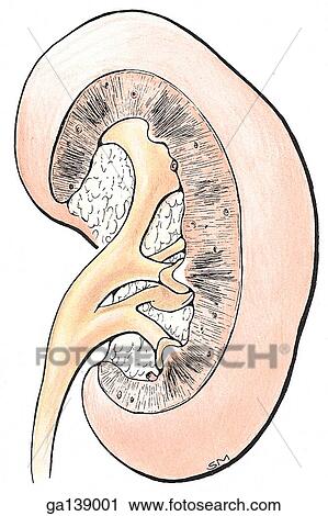 Clip Art - Illustration shows an example of bifid pelves kidney; the pelves are almost replaced by two long major calices, which lie partly within and partly outside the sinus. Front lip of kidney has been resected to expose this anomaly.. Fotosearch