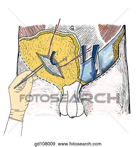 Incision of the superficial fascia to explore the potential space between the membranous layer (Scarpa's fascia) and the aponeurosis of the external oblique muscle. View Large Illustration Stock Illustration - Incision of the superficial fascia to explore the potential space between the membranous layer (Scarpa's fascia) and the aponeurosis of the external oblique muscle.. Fotosearch