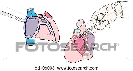 Drawing - Incisions for opening the chambers of the heart.. Fotosearch