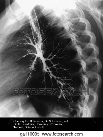 Left lateral bronchogram showing segmental bronchi. View Large Illustration Stock Illustration - Left lateral bronchogram showing segmental bronchi.. Fotosearch